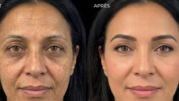 Blépharoplastie au Maroc (Rabat, Casablanca) : Prix 2026