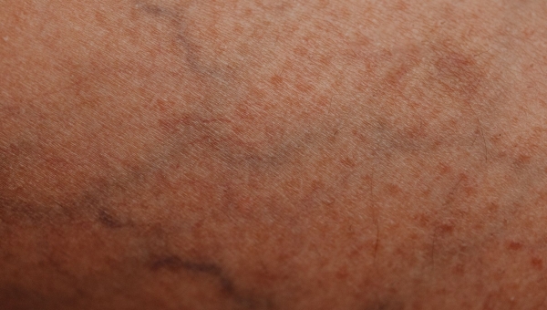 Pourquoi Voit-on les Veines à Travers la Peau ? Causes et Solutions