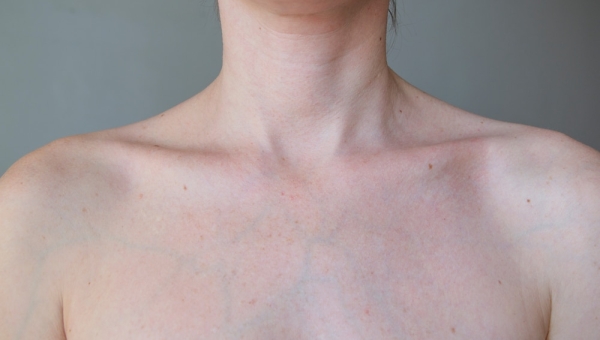 Visible Veins on the Chest: Causes, Risks and Treatments