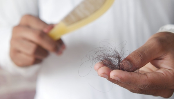 Chute de cheveux (alopécie) : causes chez l'homme et la femme, traitements efficaces