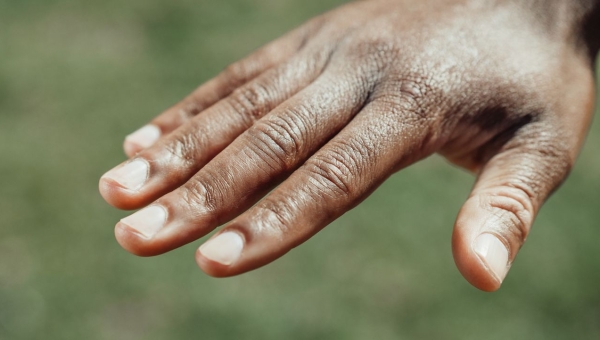Psoriasis : symptômes, formes cliniques et traitements disponibles au Maroc