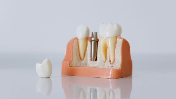 Implants dentaires au Maroc : prix et parcours