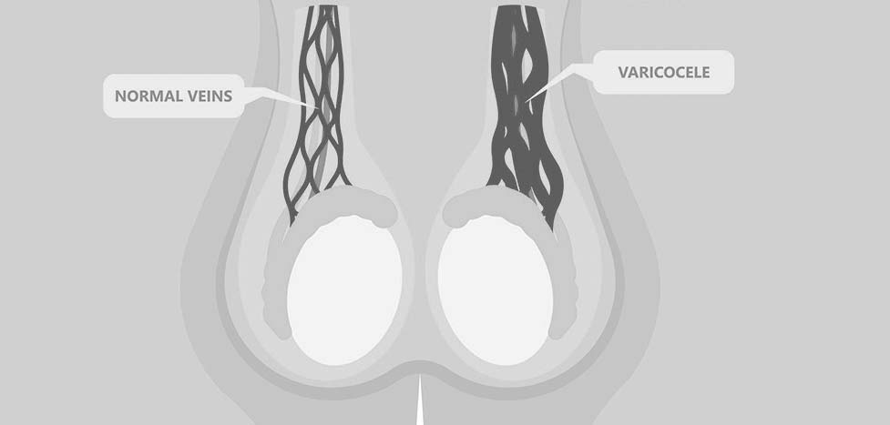 embolisation varicocele maroc casablanca